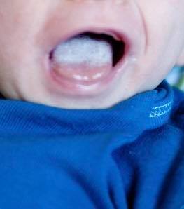 white tongue thrush